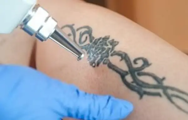 détatouage au laser de la jambe