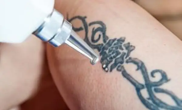 Tattooentfernung mit Laser