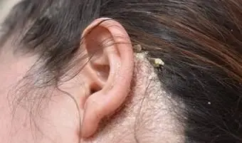 Kobieta z poważnym łupieżem