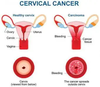 Rakovina krčka maternice