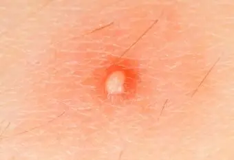 Affrontare i foruncoli legati allo stress