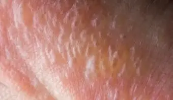 בליטות מתח על אצבעות