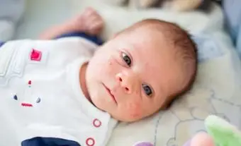 Neonato con eruzione cutanea sul viso