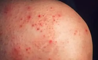 Lo stress causa petecchie?