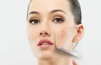 얼굴 오른쪽에만 여드름이 생기는 이유는 무엇입니까?