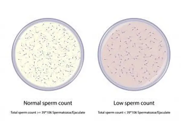 정상 및 낮은 정자 수 비교