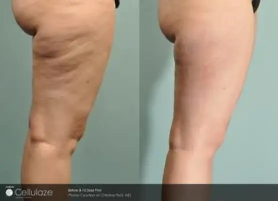 10 jours post-traitement avec Cellulaze