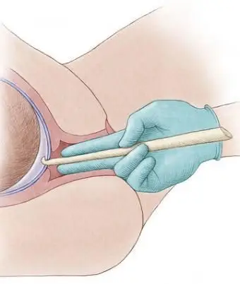 איור של מי השפיר