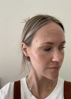 My Experience with Vascular Laser Treatment