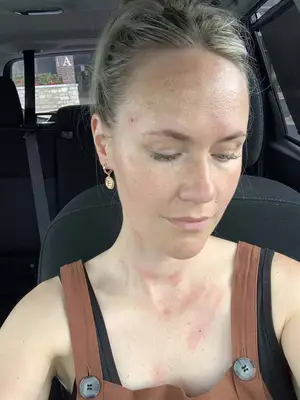 My Experience with Vascular Laser Treatment