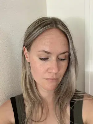 My Experience with Vascular Laser Treatment