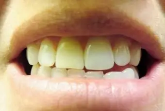 Antes de usar produtos de clareamento dentário