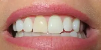 Depois de usar produtos de clareamento dentário