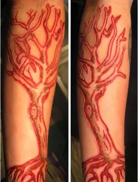 Pièce de scarification réalisée à l'aide d'un scalpel et d'un cautériseur électrique