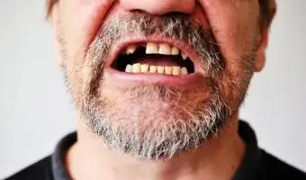 Qu'est-ce que cela signifie lorsque les dents tombent dans un rêve ?