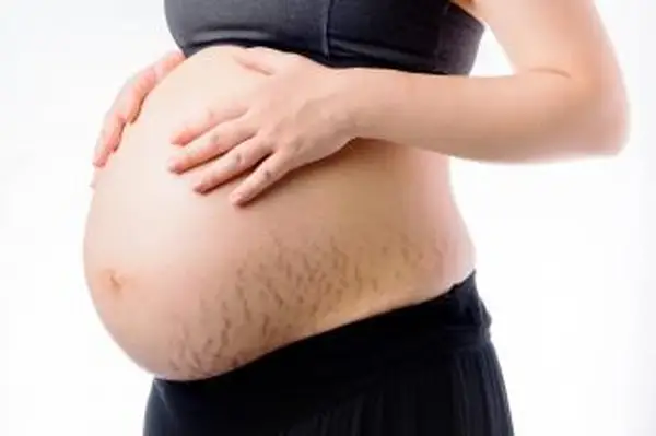 Smagliature rosse da gravidanza sulla pancia