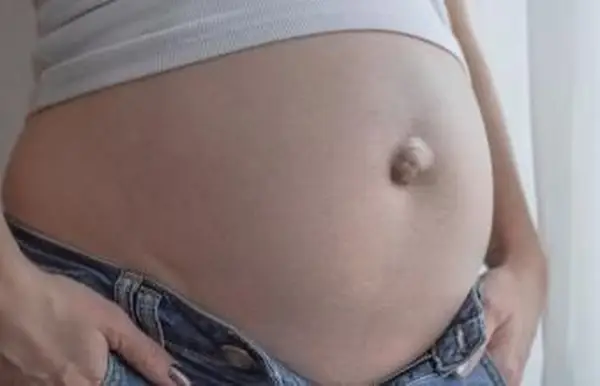 임신 중 탯줄 탈장에 대한 사실