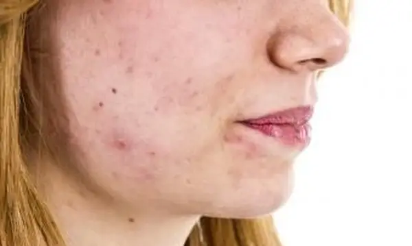 Cura de feridas em seu rosto