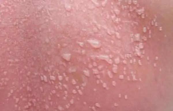 Flecken von Wasserblasen