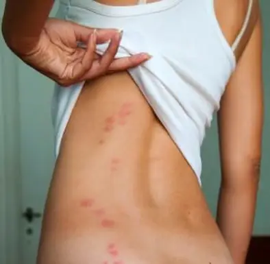 Bissspuren von Bettwanzen