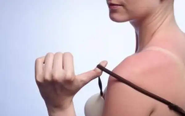 Ako dlho vydrží úpal?