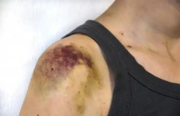 심한 타박상 후 피부 아래 딱딱한 덩어리