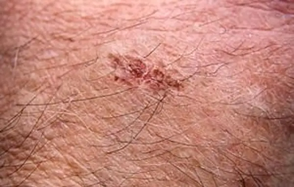 Warum jucken Wunden, wenn sie heilen?