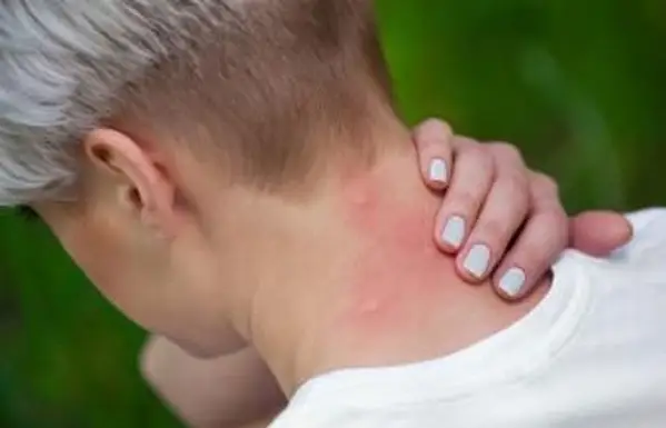 עקיצות יתושים עד צוואר