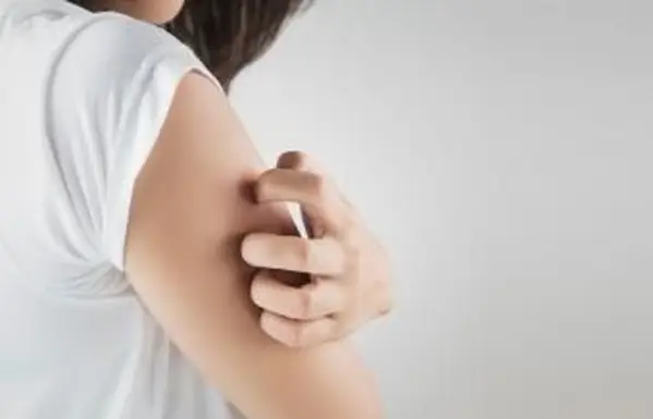 ¿Qué significa cuando las picaduras de mosquitos viejos todavía pican?