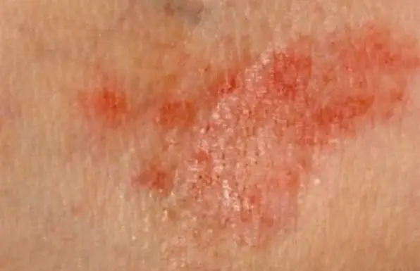 Dermatite alérgica exantema