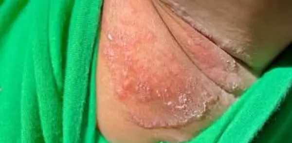 Eczema nas axilas
