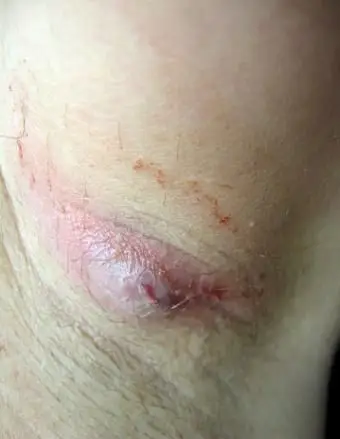 Infecção bacteriana sob a axila