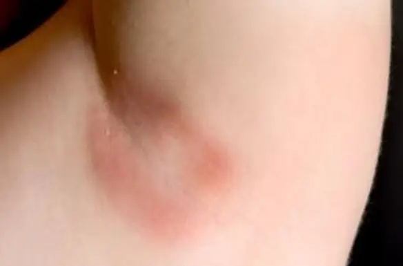 Infecção por fungos nas axilas