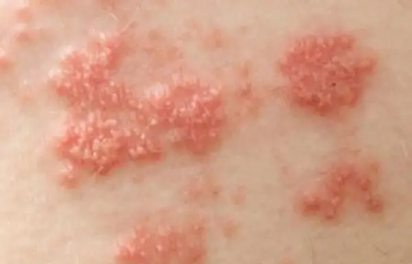 Erupção cutânea causada pelo vírus da herpes zoster