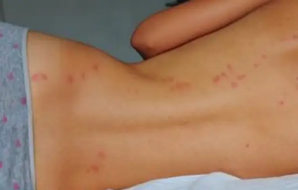 Picadas de percevejos