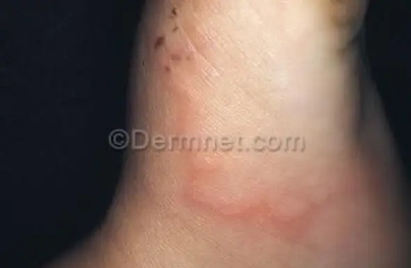 Larva Migrana Cutânea