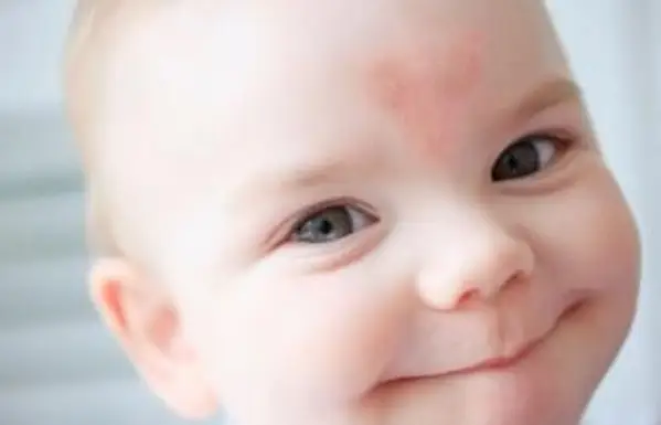 כתם לידה בצורת לב