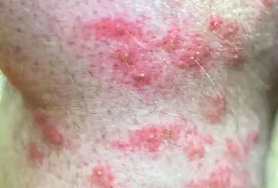 נשיכת נמלה באש