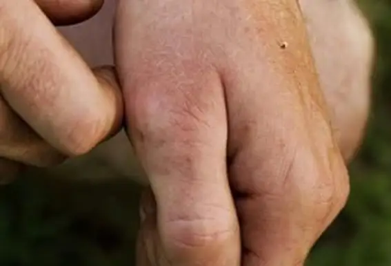 עקיצת דבורה