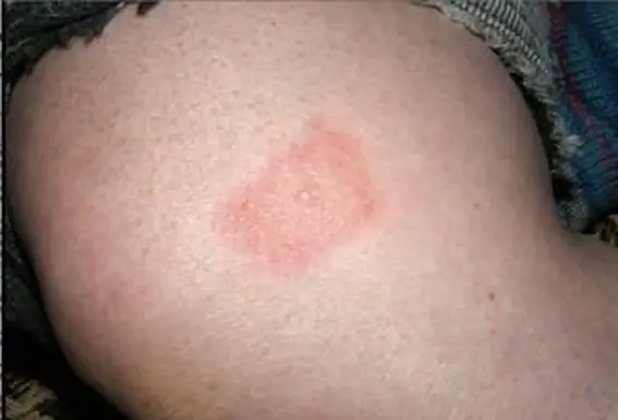 עקיצת קרציות המציגה פריחה של מחלת ליים