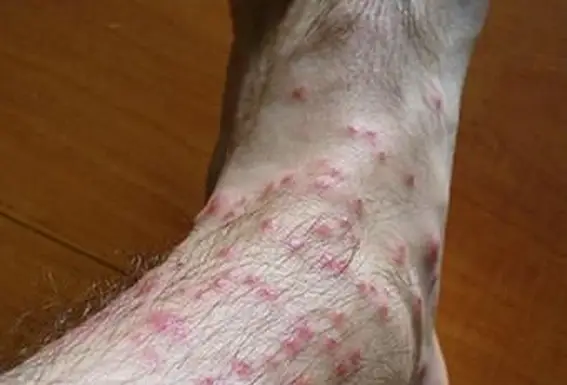 נשיכות צ'יגר