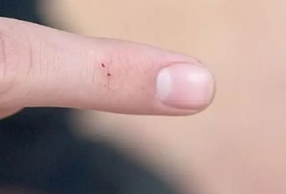 עקיצת עכביש אלמנה שחורה