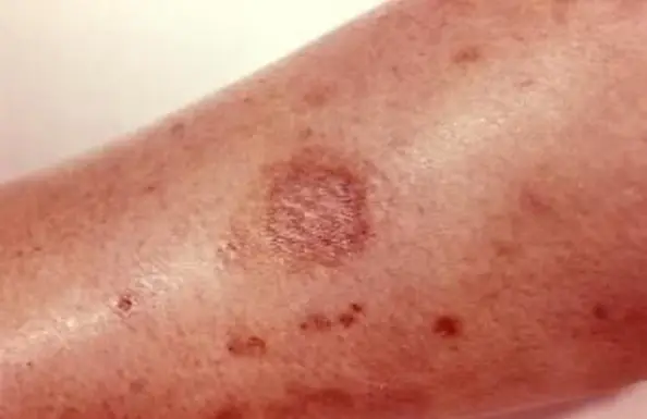 עקיצת עכביש מתבודדת חומה