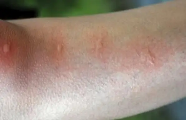 נשיכות באגים שלפוחיות