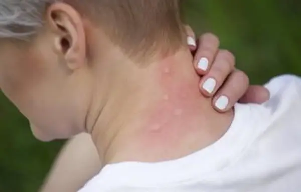 모기에 물린 것 같은 발진