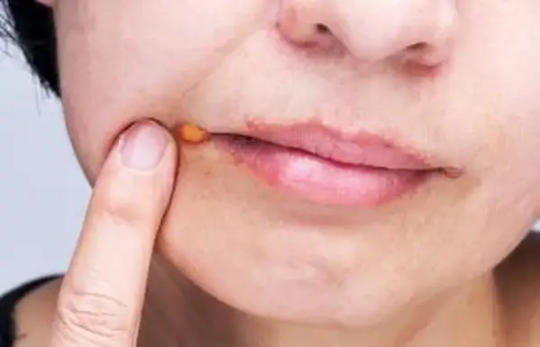 צ'יליטיס זוויתית