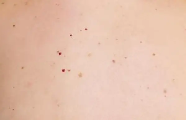 皮膚のさまざまなほくろ