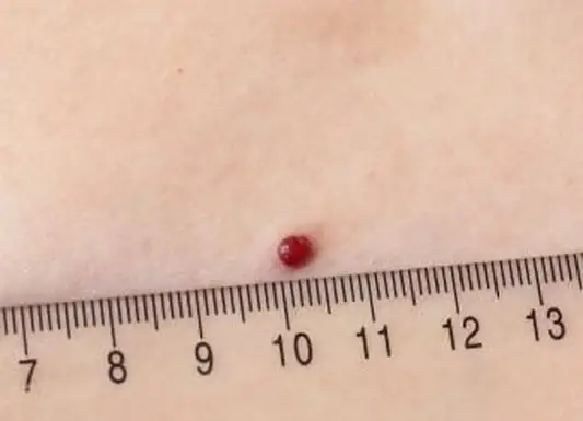 皮膚上の多数の小さな血管の非癌性の異常増殖