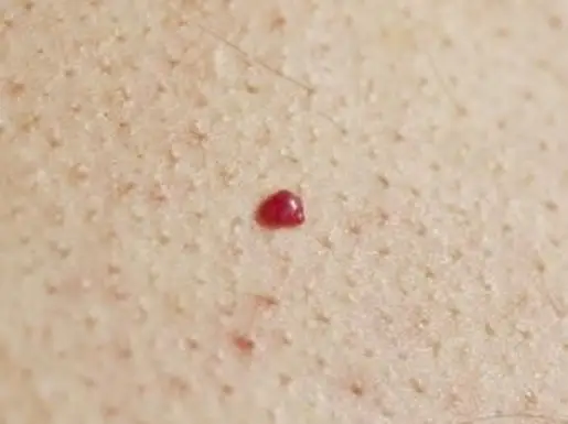 皮膚の赤いほくろ