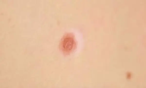 Halo Nevus